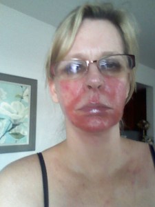 Cancer Treatment Side Effect